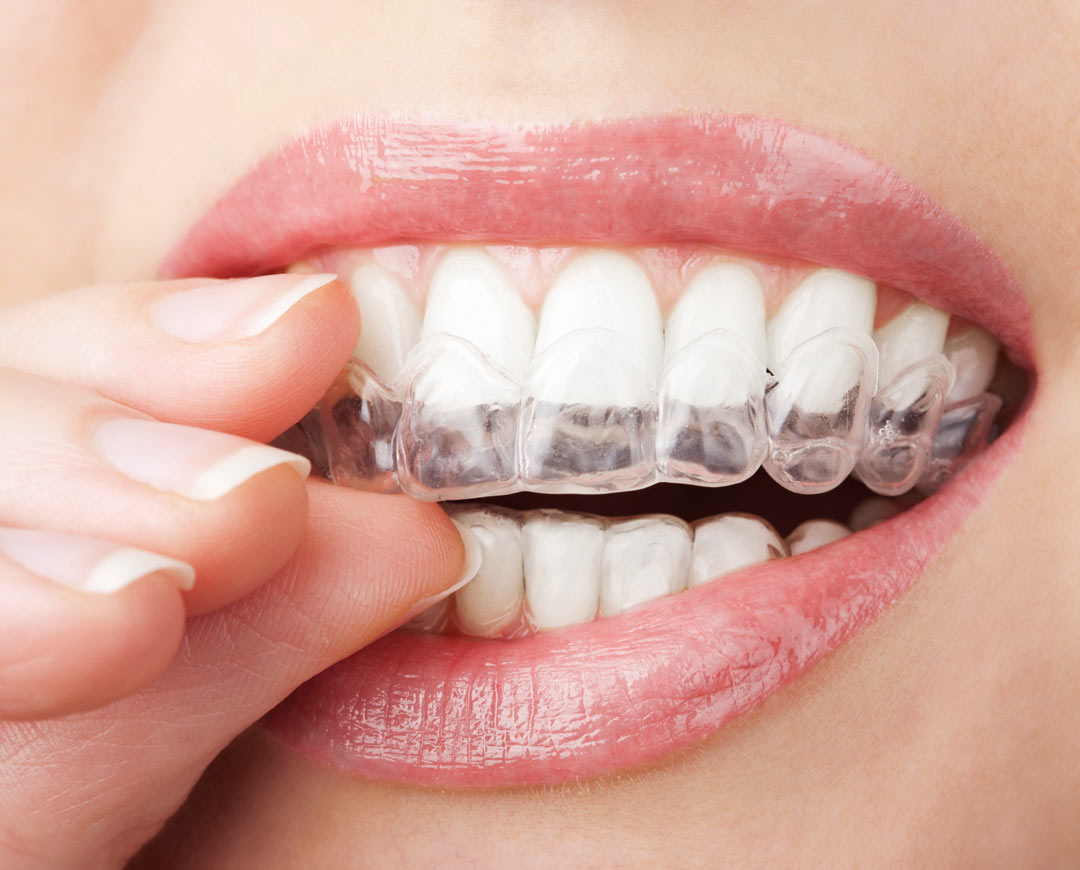 Create a perfect smile: How to choose the most cost-effective invisible braces and maintenance tips